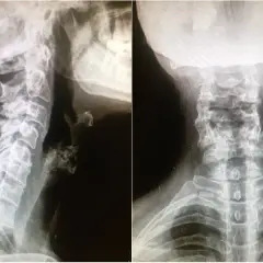 Síntomas de artrosis cervical grave: identifica el dolor y la debilidad