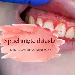 Spuchnięte dziąsło: Szybka ulga, przyczyny i kiedy do dentysty?