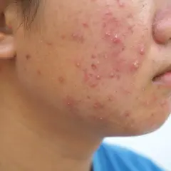 Primer plano de la mejilla de una persona con numerosos granos rojos e inflamados, algunos con pus, indicativos de acné fungico.