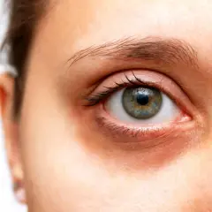 Œil humain avec des cernes visibles sous l'œil, suggérant des solutions pour comment atténuer les cernes.