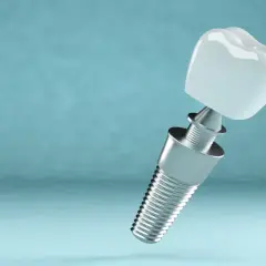 Odrzucenie implantu zęba po jakim czasie? Poznaj kluczowe czynniki