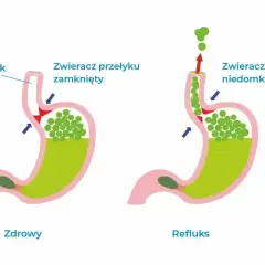 Ilustracja pokazuje refluks żołądkowo-przełykowy. Zobacz domowe sposoby na uczucie gula w gardle.