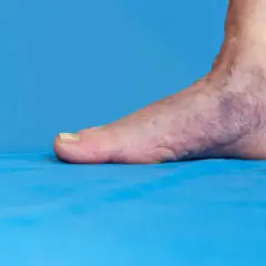 Fuß mit blauen Verfärbungen und sichtbaren Venen auf blauem Hintergrund.