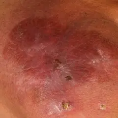Hautläsionen, die auf multiples Myelom hindeuten. Rötliche, geschwollene Stelle mit schuppiger Oberfläche und kleinen Krusten.