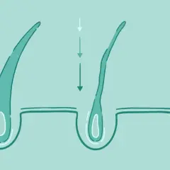 Illustration visar hur DHT påverkar hårsäckar, vilket leder till tunnare hår. Detta kan vara en orsak till håravfall hos dht kvinnor.