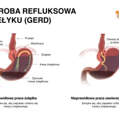 Ilustracja porównująca prawidłową i nieprawidłową pracę zwieracza przełyku, pokazująca refluks żołądkowy.