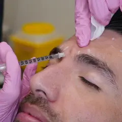 En person får medicinsk botox i pannan. Märkta punkter visar injektionsställen.