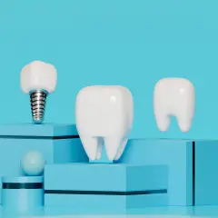Un implante dental junto a dientes, sobre cubos azules.
