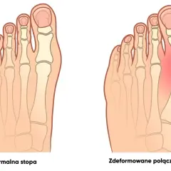 Porównanie stopy normalnej i zdeformowanej, ukazujące początki haluksów. Zniekształcone połączenie palucha z zaczerwienieniem.