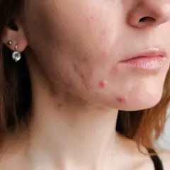 Zbliżenie na twarz młodej kobiety z widocznym trądzikiem dorosłym na policzkach i brodzie.