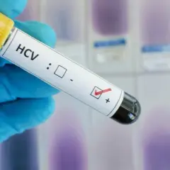 Ile kosztuje badanie HCV? Ceny, które mogą cię zaskoczyć