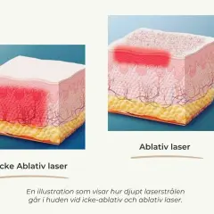 Illustrationer visar hur en co2 laser påverkar huden. Icke-ablativ laser värmer djupare, ablativ laser avlägsnar ytskiktet.