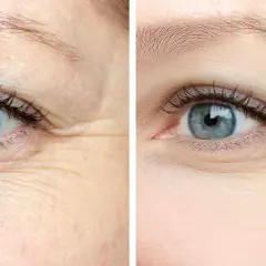 Przed i po zabiegu botox na twarz: wygładzone zmarszczki wokół oka, skóra wygląda młodziej i bardziej promiennie.