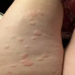 Eruzione cutanea con pomfi rossi e pruriginosi sulla pelle, possibile orticaria parainfettiva.