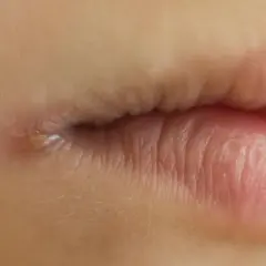 Nahaufnahme eines Mundes mit einem kleinen Pickel am Mundwinkel. Dies könnte ein Hinweis auf eine Mundrose sein, für die eine Therapie notwendig ist.