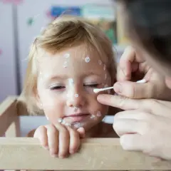 Dziecko z ospą wietrzną, któremu mama smaruje krostki. Zastanawiasz się, ospa wietrzna ile trwa? Zazwyczaj około 1-2 tygodni.
