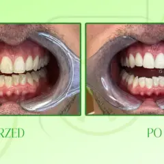 Wybielanie zębów proszkiem do pieczenia: Mit czy zagrożenie?