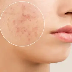 Gros plan sur une joue montrant des rougeurs et des imperfections, rappelant l'acné à 50 ans chez un homme.