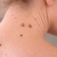 Gros grain de beauté sur le cou, peut-être un molluscum pendulum grossesse.