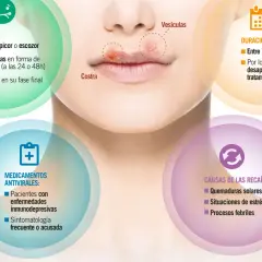 Herpes labial por estrés: el proceso incluye picor, vesículas y costras. Las recaídas pueden ser por estrés.