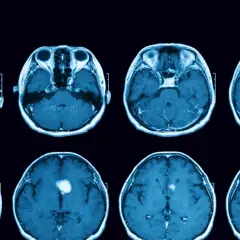 Przekroje mózgu MRI ukazujące guz przysadki, potencjalną przyczynę niedoczynności przysadki mózgowej.