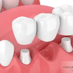 Dettaglio di una capsula devitalizzazione dente, con ponti dentali che coprono monconi preparati.