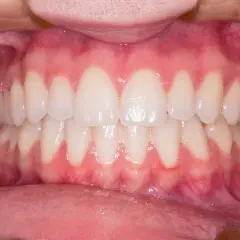 Gengive rosse e gonfie, con segni di sanguinamento gengive quando preoccuparsi. Denti bianchi e allineati.