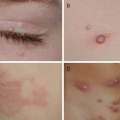 Lesiones de moluscos contagiosos en niños: párpados, tronco y abdomen.