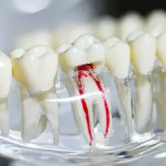 Model zęba z widocznym uszkodzonym kanałem korzeniowym, ilustrujący potrzebę leczenia endodontycznego.