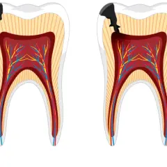 Secuencia de caries que avanza hacia la pulpa dental, mostrando la progresión de la pulpitis muela.