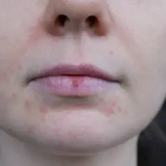 Skóra wokół ust z zaczerwienieniami i wypryskami, wskazująca na zapalenie okoloustne.