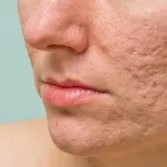 Närbild på en persons kind med synliga ärr och hål i huden efter pormask.