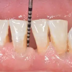 Sonda parodontale misura la profondità di un solco gengivale. Le tasche gengivali possono guarire con cure adeguate.
