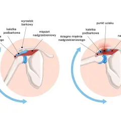 Ilustracja pokazuje ucisk na ścięgno mięśnia nadgrzebieniowego, co może wywoływać ból. Czy kości są unerwione? Nie, ale tkanki wokół nich tak.
