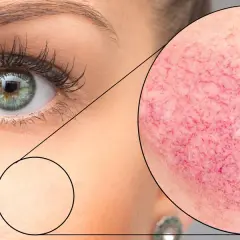 Rumień i pajączki? Jak skutecznie pozbyć się cery naczynkowej