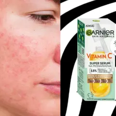 Skóra z zaczerwienieniami i niedoskonałościami. Obok opakowanie serum Garnier z witaminą C na przebarwienia, obiecujące efekty już po 6 dniach.