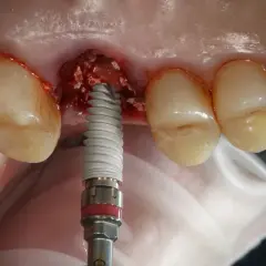 Impianto dentale in corso. Evitare di fumare dopo l'intervento per favorire la guarigione.