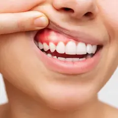 Dente con un piccolo puntino bianco sulla gengiva infiammata, evidenziato da un dito.