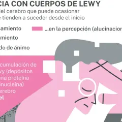 La demencia con cuerpos de Lewy afecta pensamiento, movimiento, ánimo y percepción. Se debe a depósitos de proteína alfa-sinucleína en el cerebro.
