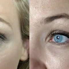 Vergleich zweier Augen: Links mit deutlichen dunklen Augenringen, rechts mit aufgehellter Hautpartie unter dem Auge.