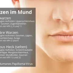 Informationen zu HPV im Mund: Feig-, vulgäre und Morbus Heck-Warzen. Erfahren Sie mehr über die Ursachen und Symptome.