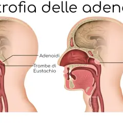 Confronto tra adenoidi normali e ingrossate che ostruiscono le trombe di Eustachio.