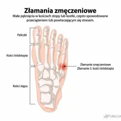 Złamanie zmęczeniowe 5. kości śródstopia, widoczne jako czerwona plama na szkielecie stopy.