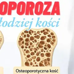 Osteoporoza: cichy złodziej kości. Porównanie zdrowej i osteoporotycznej kości. Szkielet z zaznaczonym bólem w obrębie barku.