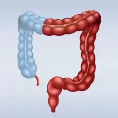 Ilustracja jelita grubego, gdzie prawa strona (czerwona) jest połączona z lewą (niebieską), symbolizując stan po hemikolektomii prawostronnej.