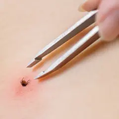 Urwał się kleszcz? Jak bezpiecznie usunąć resztki z ciała.