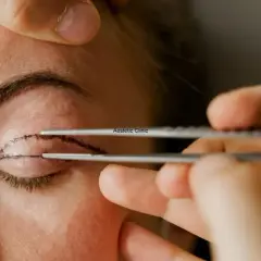 Przygotowanie do korekty powiek górnych. Chirurg zaznacza linię cięcia na skórze pacjentki.