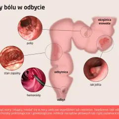Ilustracja przedstawia przyczyny bólu w odbycie: polipy, stan zapalny, hemoroidy, raka jelita, okrężnicę esowatą.