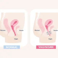 Comparaison anatomique : vagin normal et vaginisme. Le vaginisme peut causer une douleur au plancher pelvien due à une contraction involontaire.