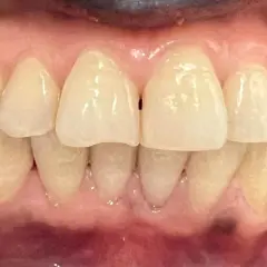 Primer plano de dientes y encías, mostrando algunas manchas oscuras en las encías.